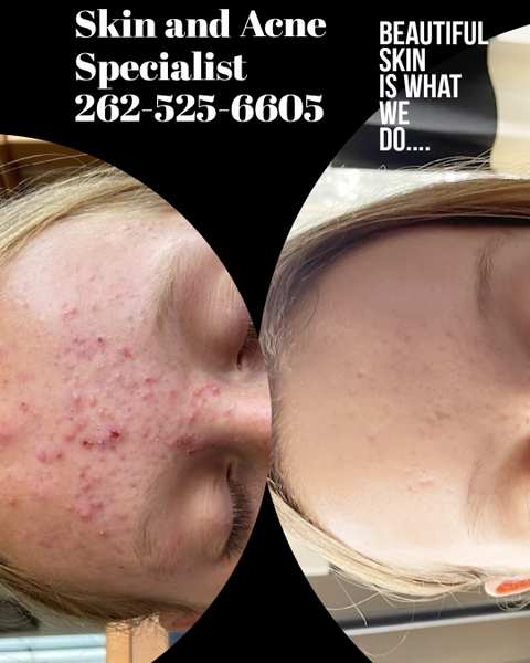 Skin and Acne Specialist & The Washington County School of Esthetics — photo 3